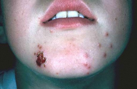 Herpes simplex | American Academy of Dermatology